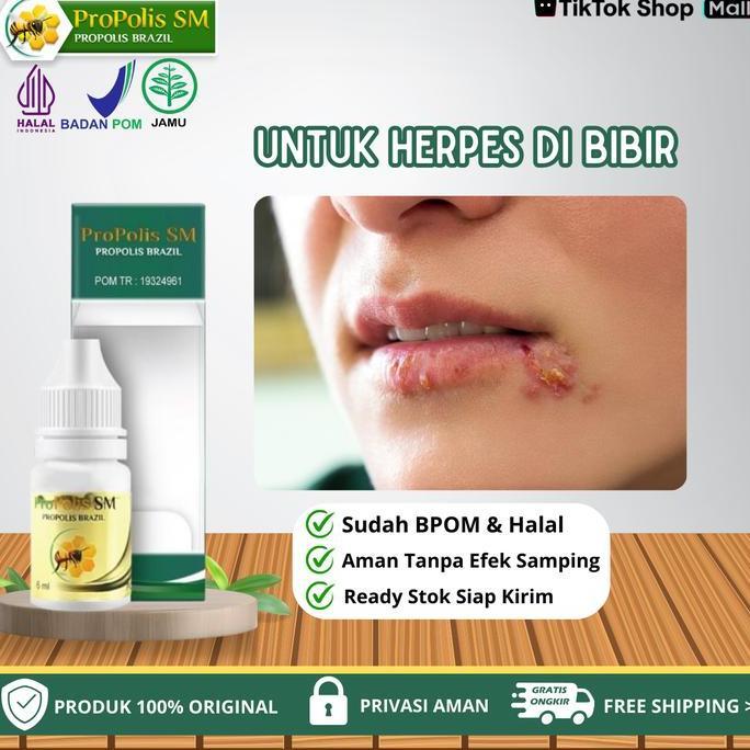 Propolis SM - Solusi Untuk Pengering Herpes Berair Di Bibir, Gatal Bintik Berair Di Bibir