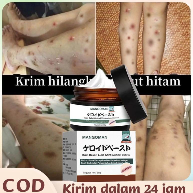 Krim Penghilang Bekas Luka Obat Penghilang Bekas Luka Bekas Luka Jahitan Gigitan Serangga Bekas Luka