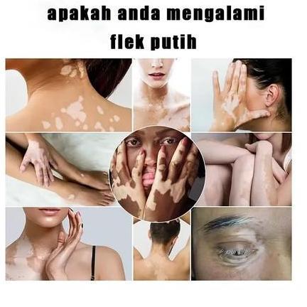 PENGOBATAN VITILIGO OBAT VITILIGO AMPUH /PROTOPIC VITILIGO ALEP VITILIGO, PANU, BIANG KERINGAT, SALE