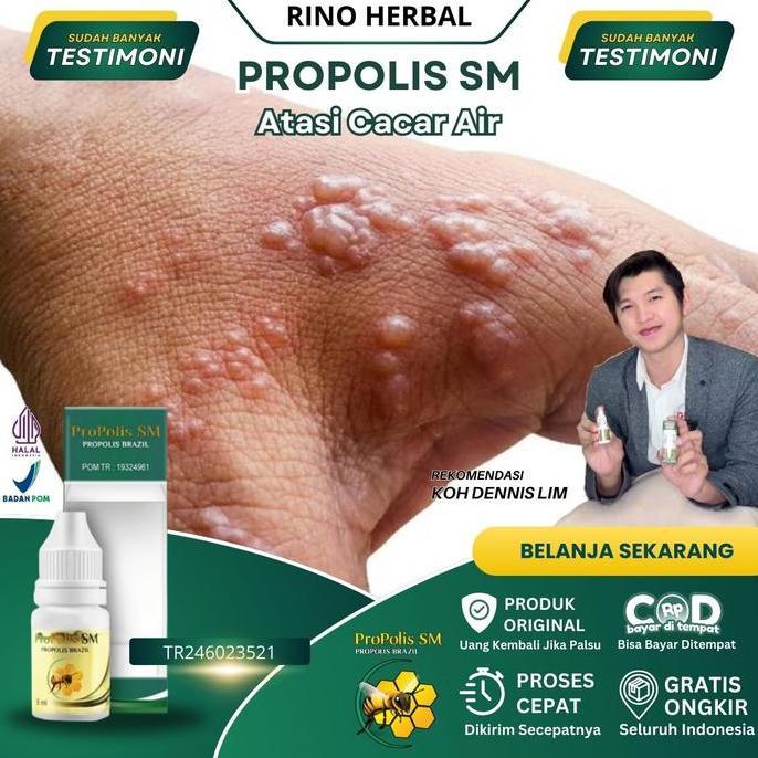 Obat cacar air & bekas cacar, Obat herpes zoster, Obat gatal berair, Salep cacar air, Obat cacar api