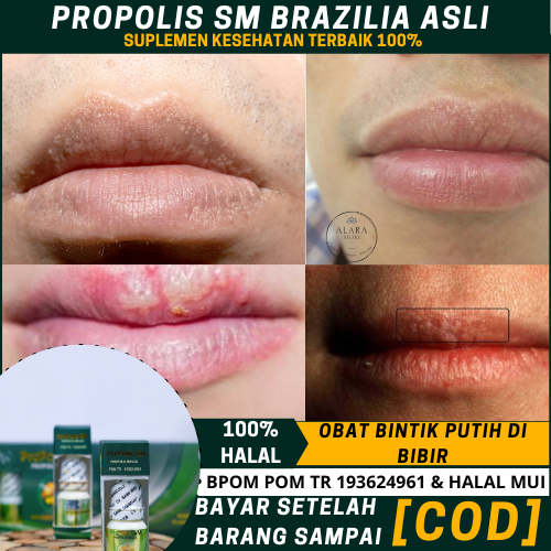 Obat Fordyce Spots, Bintik Bening Di bibir, Obat Penghilang Bintik Putih Di bibir,   Obat Herpes Bib