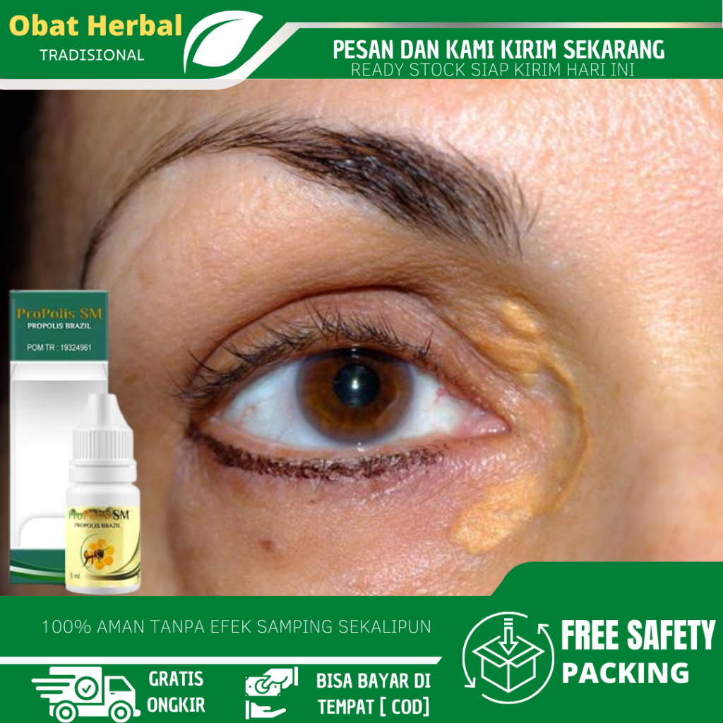 Obat Untuk Menghilangkan Xanthelasma, Obat Oles Penghilang Xanthelasma, Obat Gumpalan Lemak Di Kelop