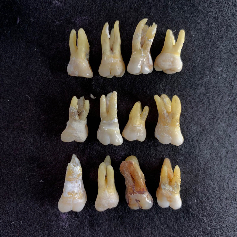 Gigi praktikum fkg Molar 1 Rahang atas