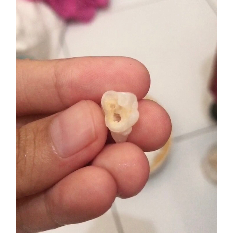 Gigi Molar Anak Bukav