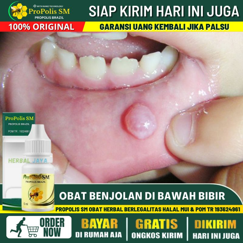 Obat Pengempis Benjolan di Bawah Bibir 100% Alami, Obat Benjolan Mucocele Pada Anak & Dewasa, Sariaw