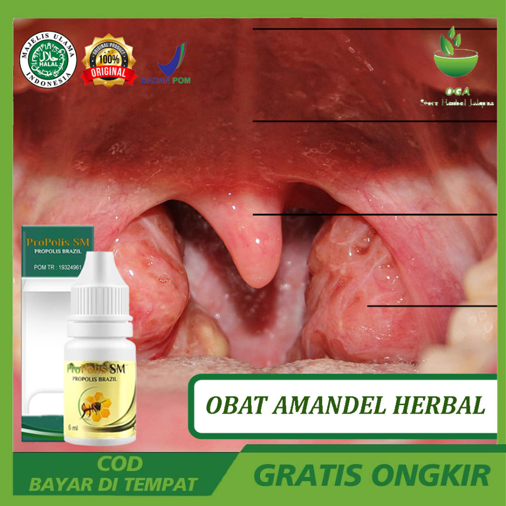 Obat Khusus Amandel Herbal Untuk Anak Dan Dewasa - Penghancur Amandel - Pengempes Amandel - Radang T