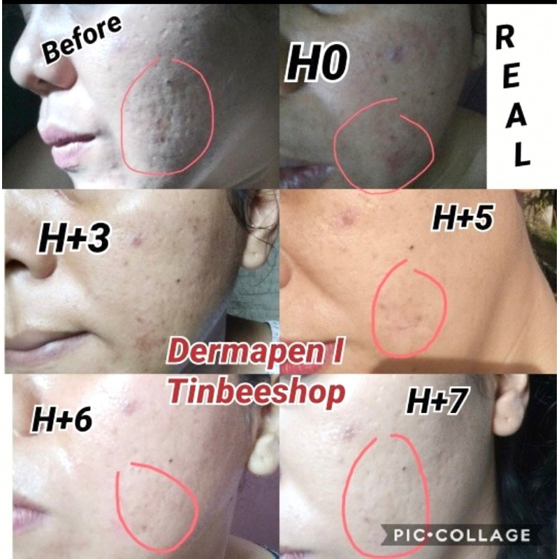 SET PAKET DERMAPEN dermaroller MTS scats bopeng flek glow