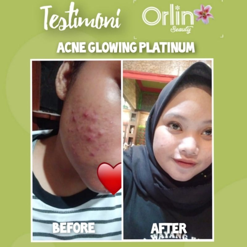 ORLIN BEAUTY paket jerawat / paket acne glowing/ bonus gift cantik