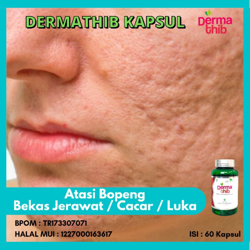 ( COD ) Dermatib Kapsul Untuk Menghilangkan Bopeng Muka Bekas Jerawat / Bekas Cacar - Kapsul Jerawat