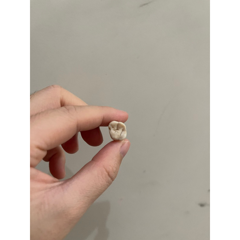 Gigi Molar 1 Rahang Atas