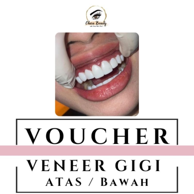 Voucher Veneer Gigi Atas / Bawah