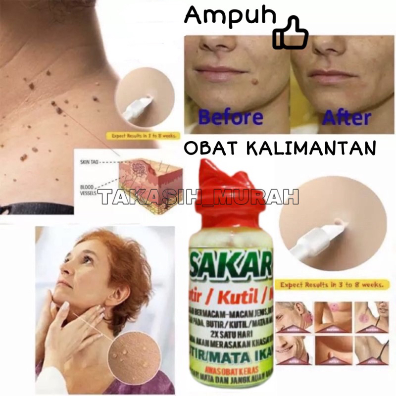 Obat Oles Penghilang Kutil Tahi Lalat , Butir &amp; Mata Ikan