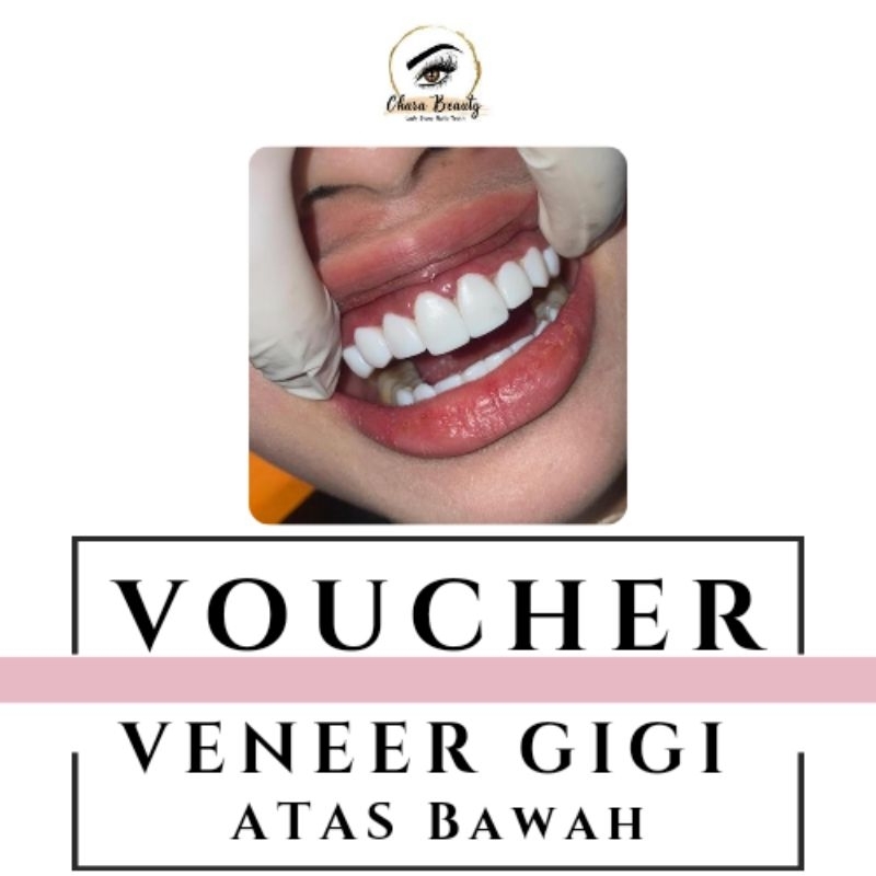 Voucher Veneer Gigi Atas Bawah