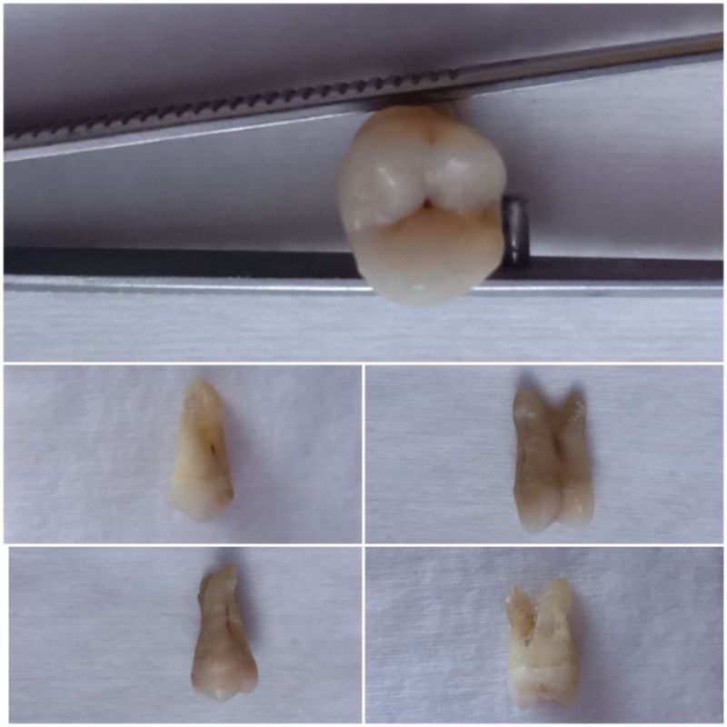 GIGI MOLAR RAHANG ATAS/GIGI MOLAR/GIGI ASLI