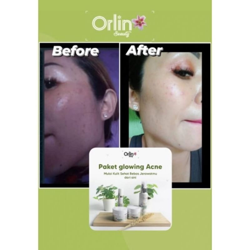 ORLIN BEAUTY paket jerawat / paket acne glowing/ bonus gift cantik