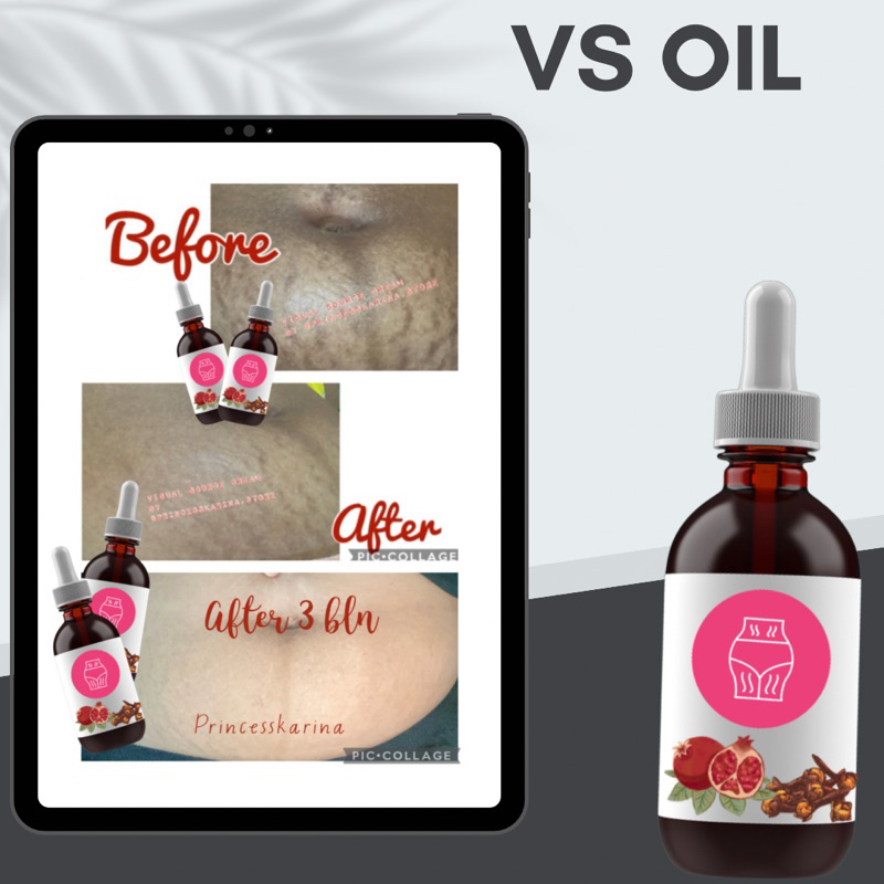 MINYAK stretch mark / cream stretch mark
