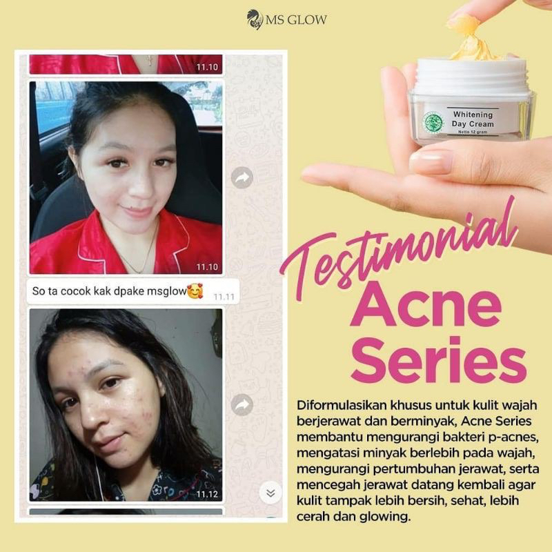 MS GLOW PAKET ACNE / PAKET ACNE MS GLOW