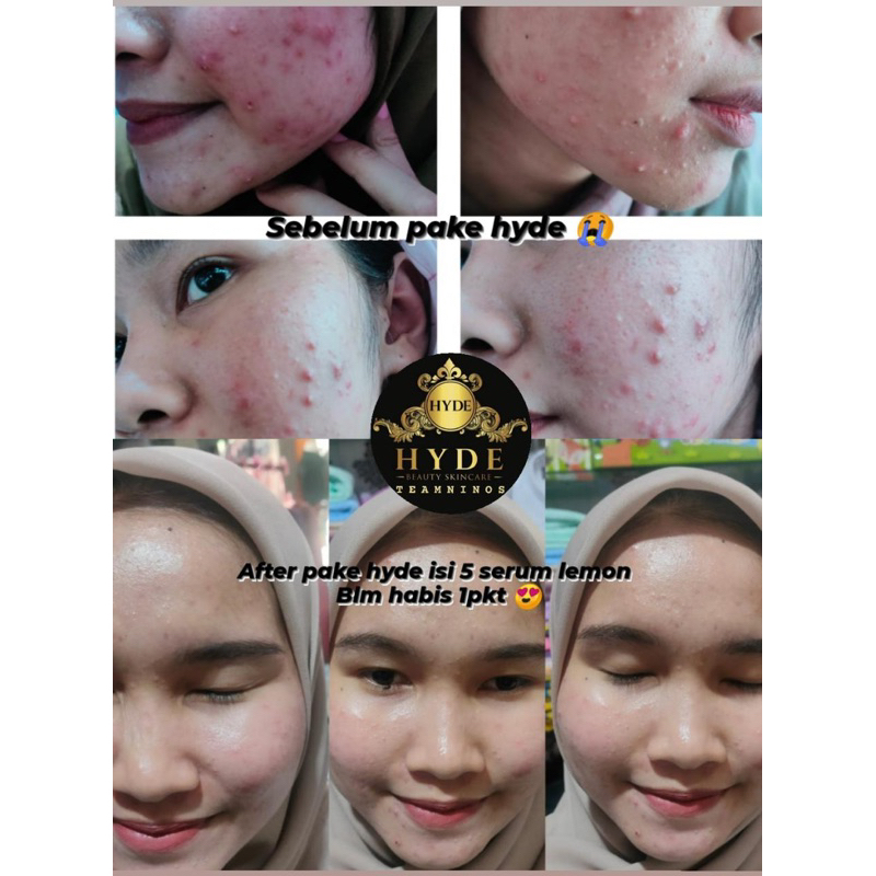 ( FREE MINI GOLD ) HYDE BEAUTY SKINCARE ALL VARIAN ( UNTUK SEMUA JENIS KULIT )