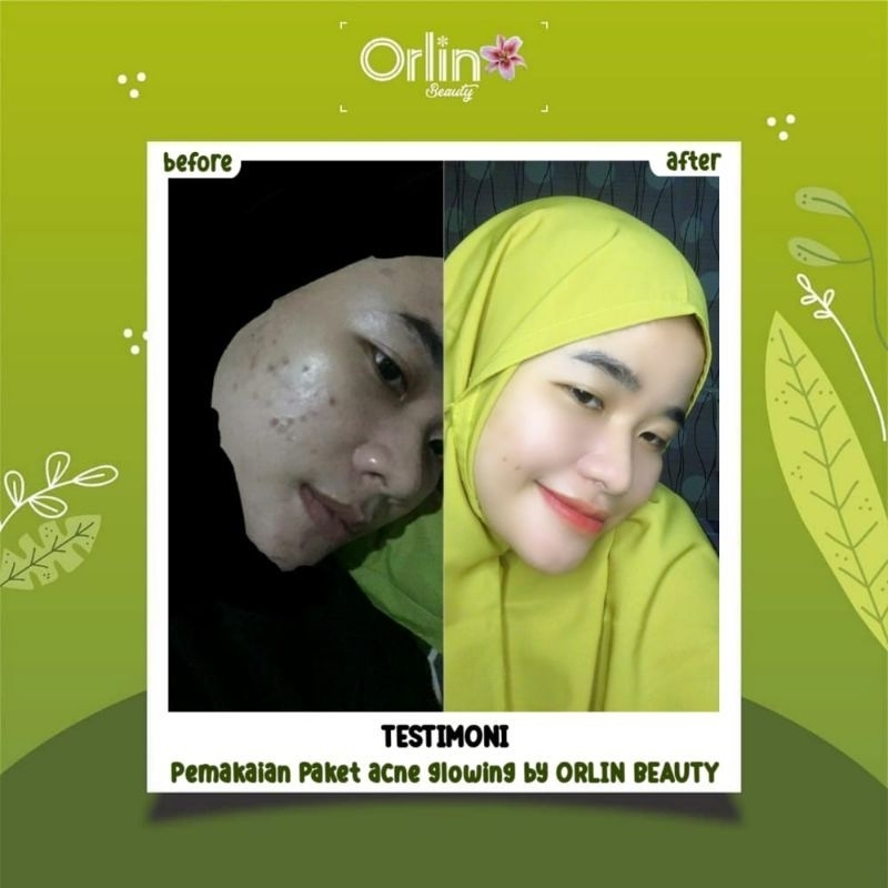 ORLIN BEAUTY paket jerawat / paket acne glowing/ bonus gift cantik