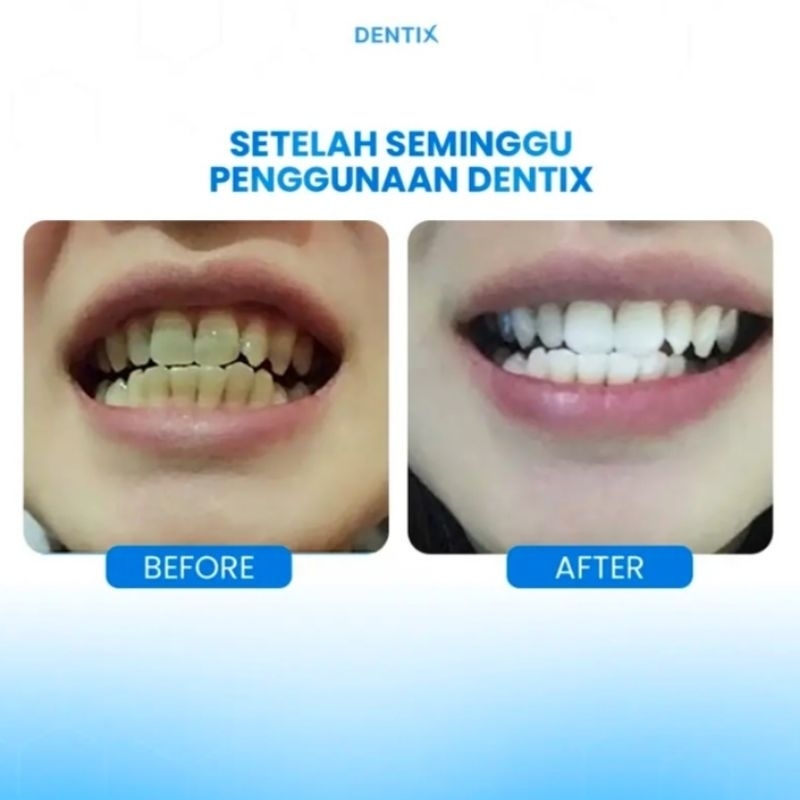 DENTIX TEETH WHITENING EXPERT MEMUTIHKAN GIGI KUNING