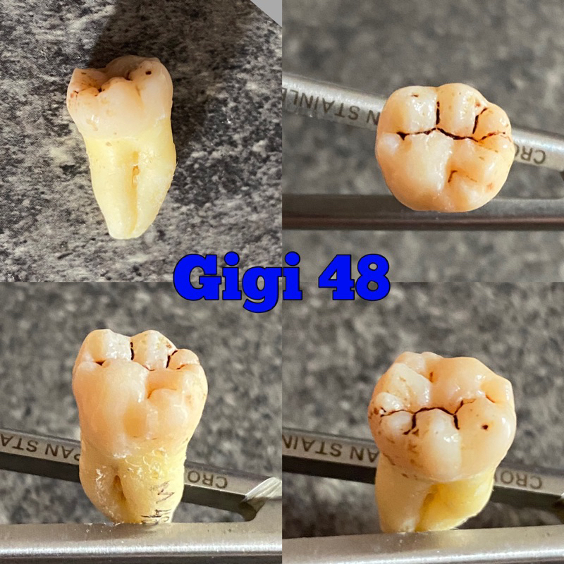 gigi molar/geraham asli manusia