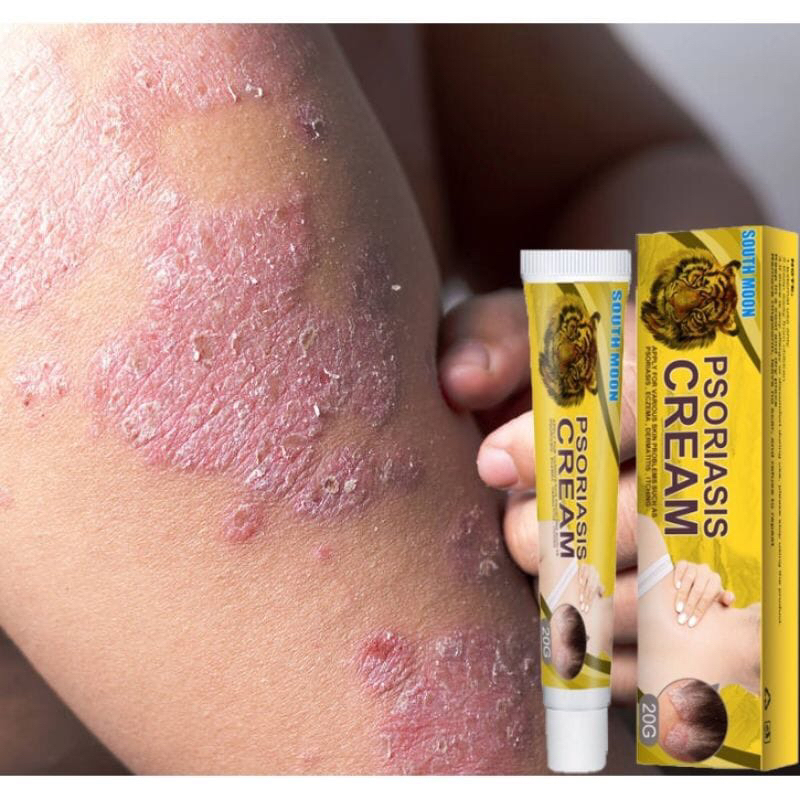 Salep Gatal Gatal ampuh mengatasi Psoriasis eksim gatal bernanah/Salep gatal Salep kulit Krim perbaikan gatal kulit Krim psoriasis 20g Salep eksim Bahan obat Cina yang sehat Pengobatan penyakit kulit