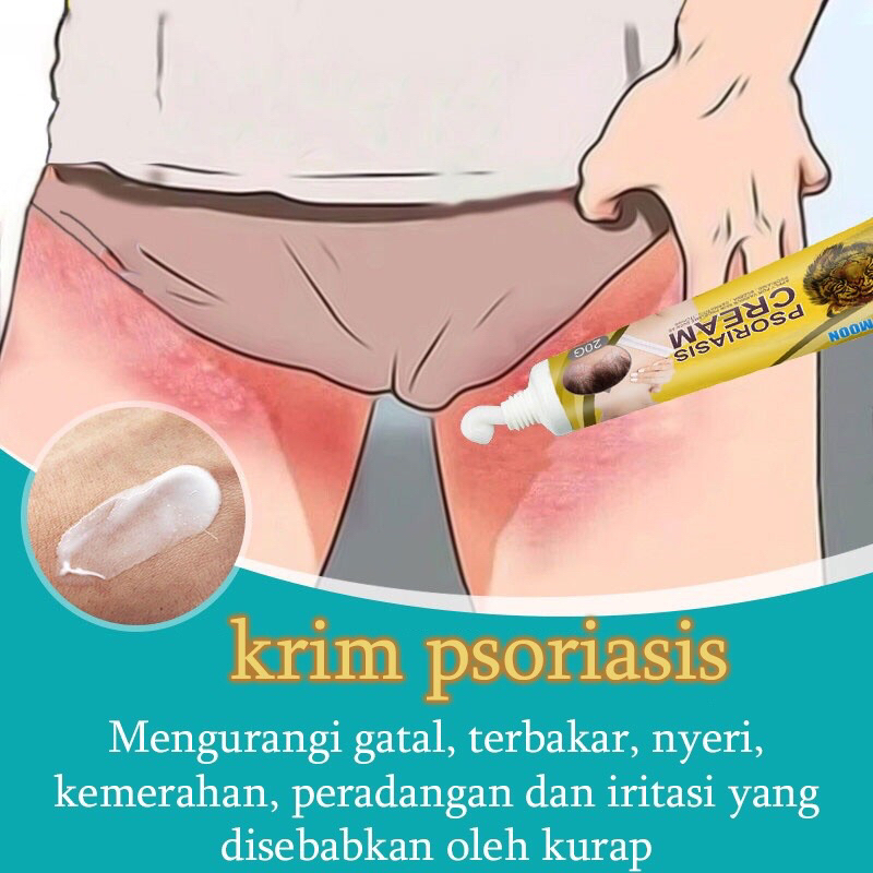 Salep Gatal Gatal ampuh mengatasi Psoriasis eksim gatal bernanah/Salep gatal Salep kulit Krim perbaikan gatal kulit Krim psoriasis 20g Salep eksim Bahan obat Cina yang sehat Pengobatan penyakit kulit