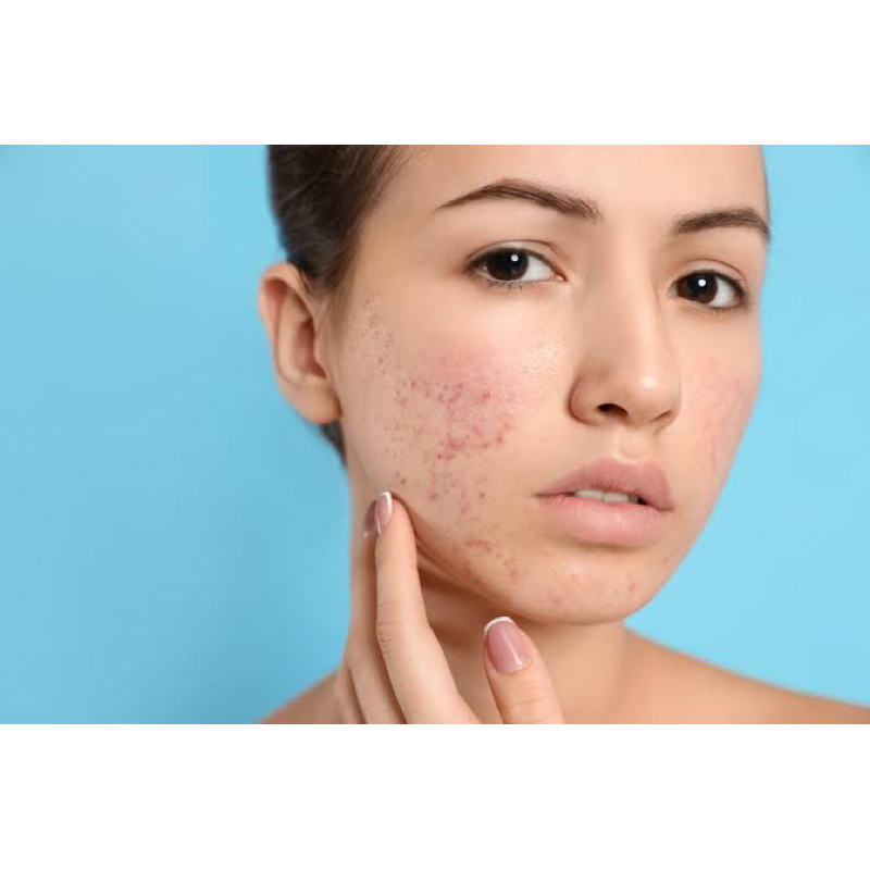 Facial Diamond + Dermapen Acne Booster Serum