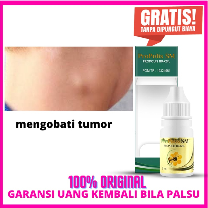 Obat Tumor, tumor ganas, tumor jinak obat herbal propolis sm Brazil herbal alami asli original