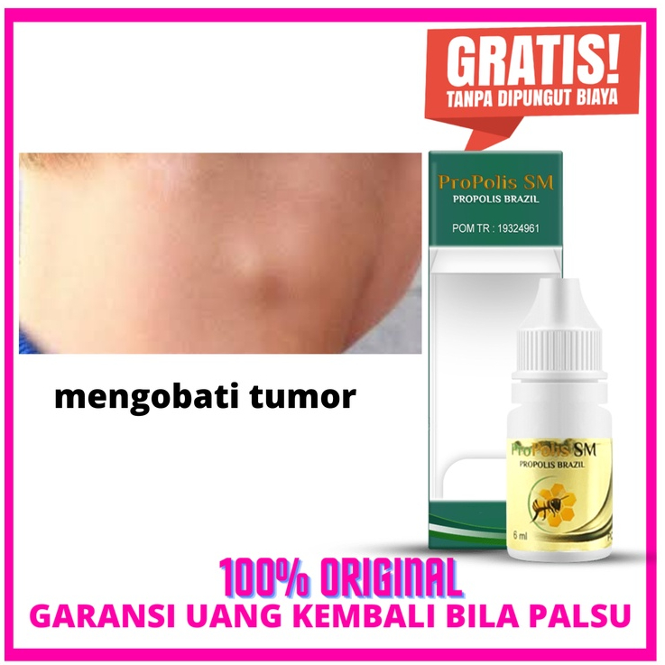 Obat Tumor, tumor ganas, tumor jinak obat herbal propolis sm Brazil herbal alami asli original