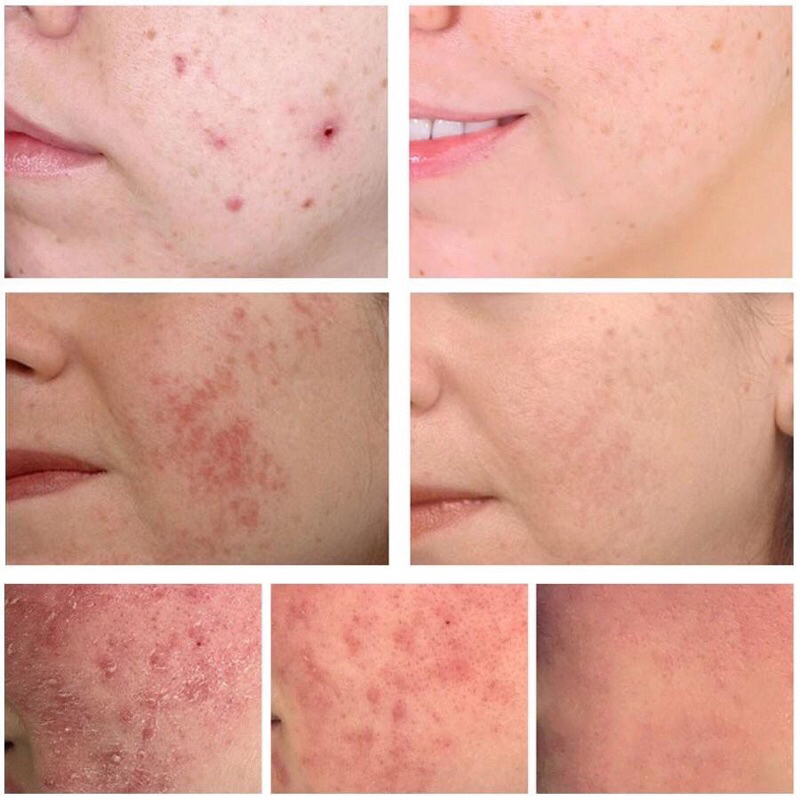 Breylee acne treatment serum - 17ml