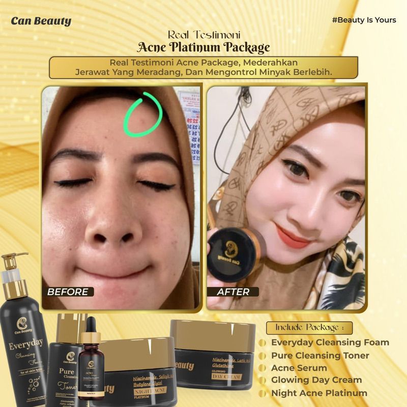 (FREE GIFT PARFUM DSULTHAN) CAN BEAUTY ACNE PLATINUM PACKAGE