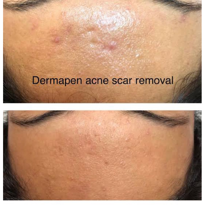 Facial Diamond + Dermapen Scar Serum