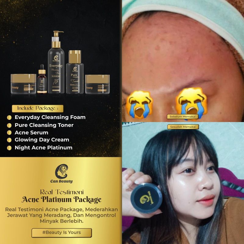 (FREE GIFT PARFUM DSULTHAN) CAN BEAUTY ACNE PLATINUM PACKAGE