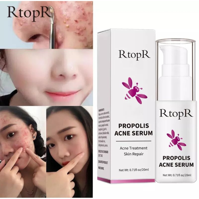 Rtopr Propolis Acne Serum/Acne Treatment Skin Repair 20ml