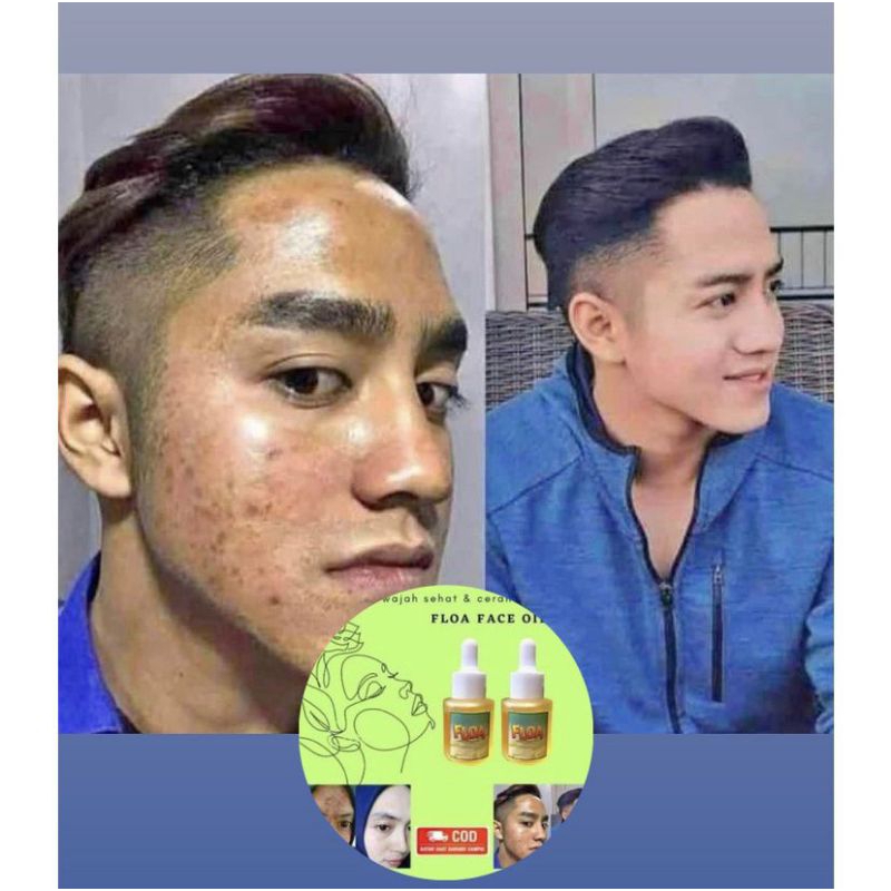 SERUM WAJAH, PEMUTIH WAJAH, PENGHILANG JERAWAT, BEKAS JERAWAT, BOPENG FLOA FACE OIL