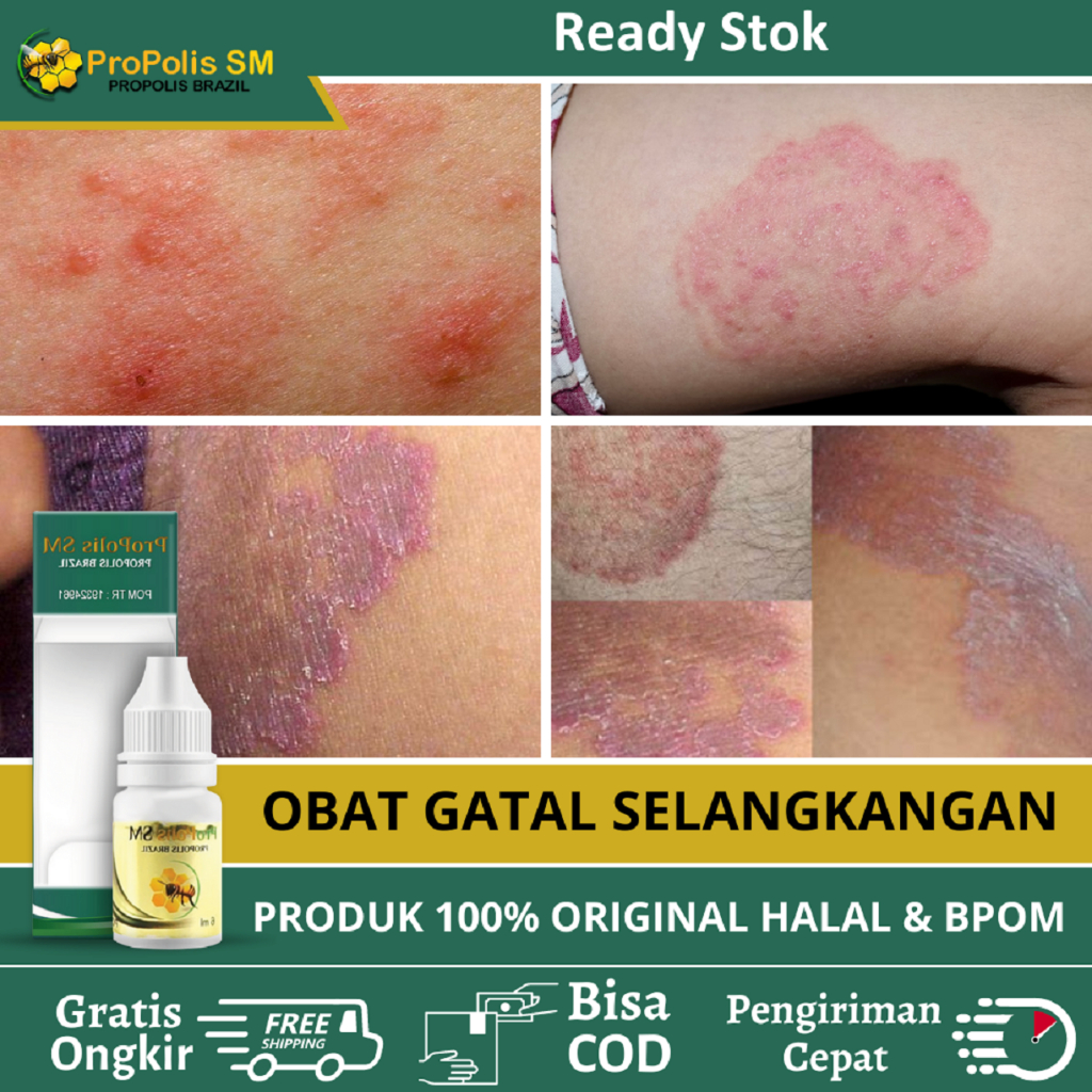 Obat Gatal Selangkangan, Obat Gatal Di Selangkangan, Obat Jamur Selangkangan, Obat Selangkangan Hita