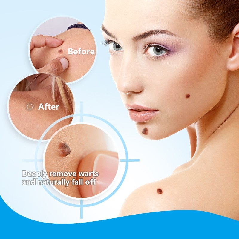 Krim Penghilang Tahi Lalat di Wajah Permanen - Sumifun Wart Remover Original