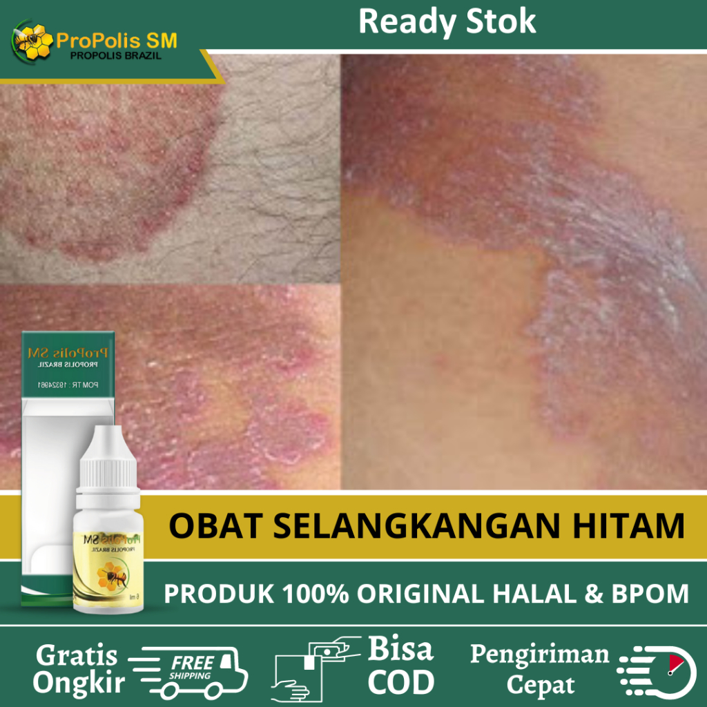 Obat Masalah Kulit Gatal Di Selangkangan Pria Wanita, Obat Gatal Selangkangan, Obat Selangkangan Hit