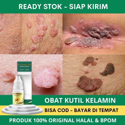 Obat Kutil Kelamin HPV - Obat Kutil Di Kelamin - Obat Kutil Kelamin - Obat Kutil Kemaluan - Obat Pen
