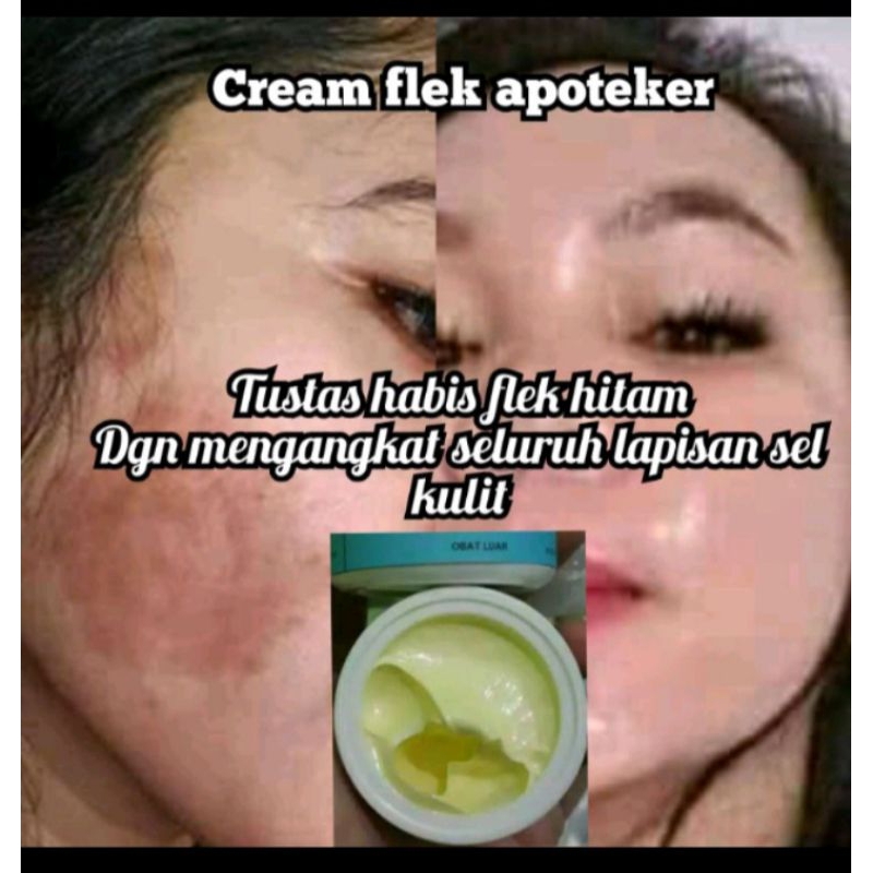 Cream Penghilang Flek Hitam Membandel di Wajah / cream flek khusus flek bandel dan wajah kebal / sus