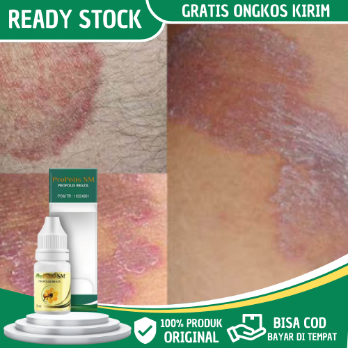 Obat Gatal Selangkangan, Obat Selangkangan Gatal Dan Hitam, Obat Gatal/Kurap Selangkangan, Lecet Sel