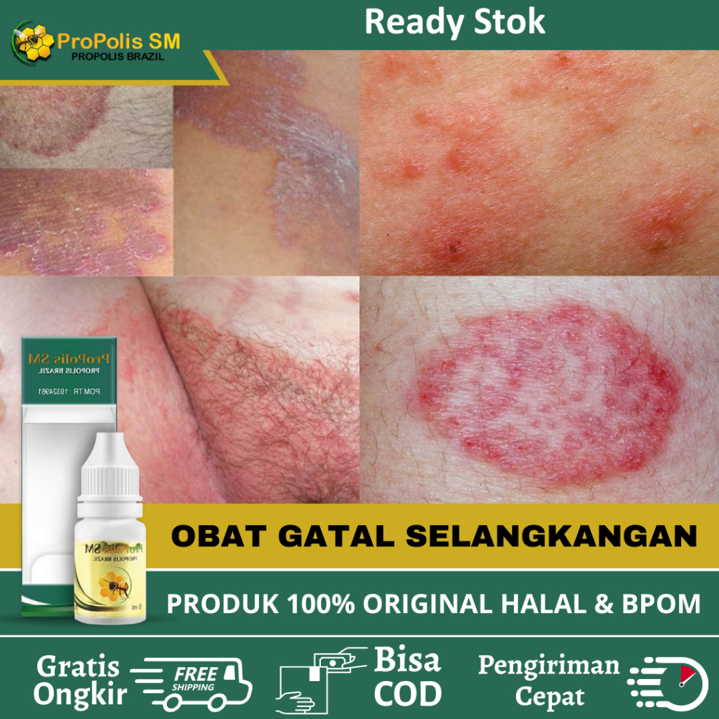 Obat Gatal Selangkangan, Obat Masalah Kulit Gatal Di Selangkangan Pria Wanita, Obat Selangkangan Hit