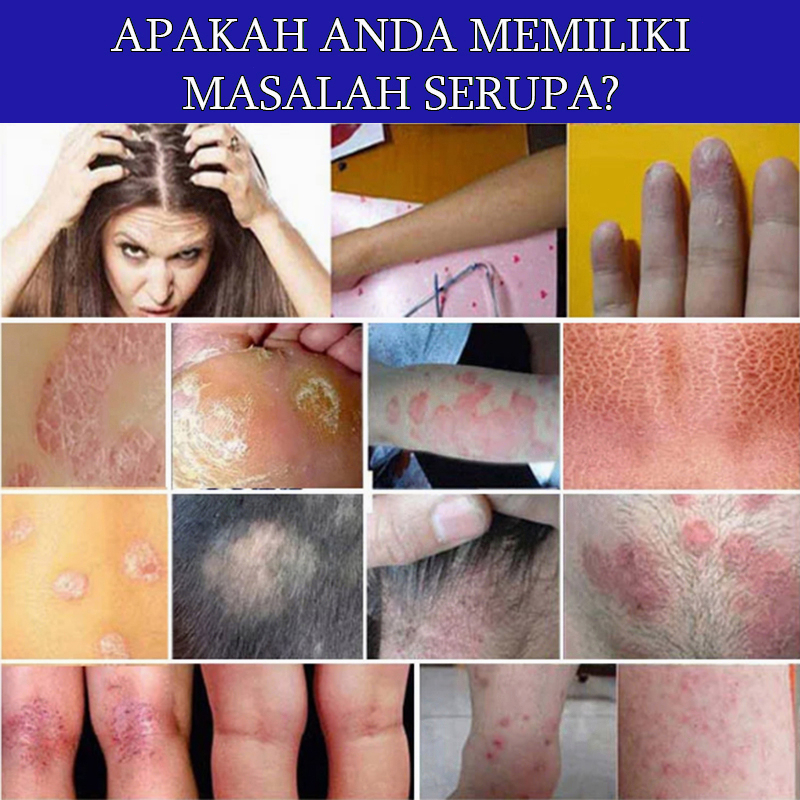 OBAT GATAL KULIT OBAT GATAL KULIT PALING AMPUH Salep gatal Salep Eksim 20g Psoriasis Salep Antibiotik  Krim Gatal Anti Bakteri Anti Gatal Di Tangan/Anti Gatal Di Kaki/Anti Gatal Di Kemaluan/Anti Gatal Di Bpom