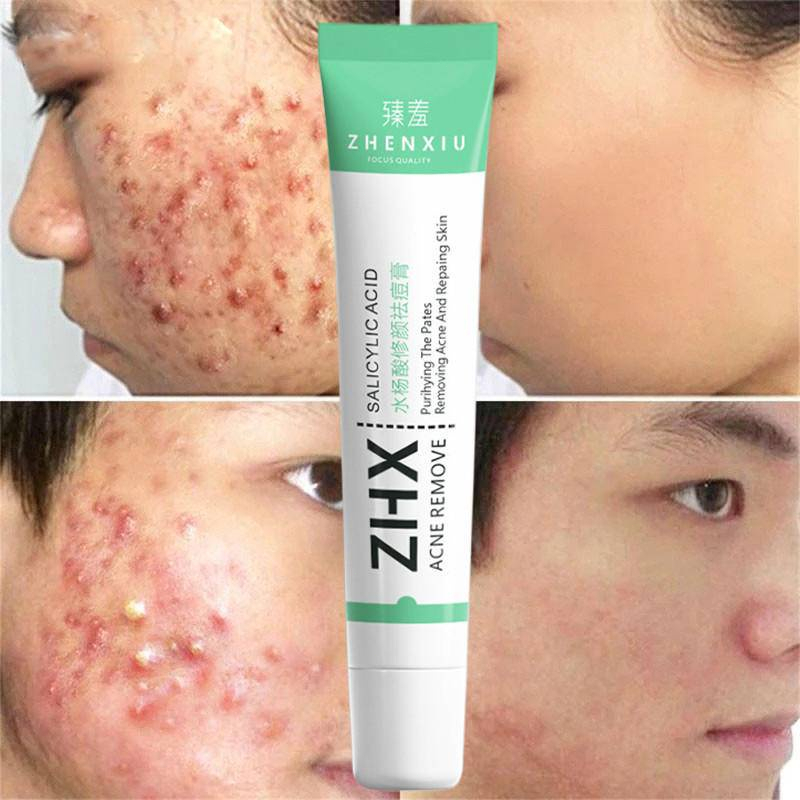 ZHENXIU Krim Anti jerawat dan Memudarkan bekas jerawat Cepat Salep Jerawat 20g Original Anti acne Herbal Essence Menghilangkan Jerawat Memperbaiki Kulit Pria dan Wanita