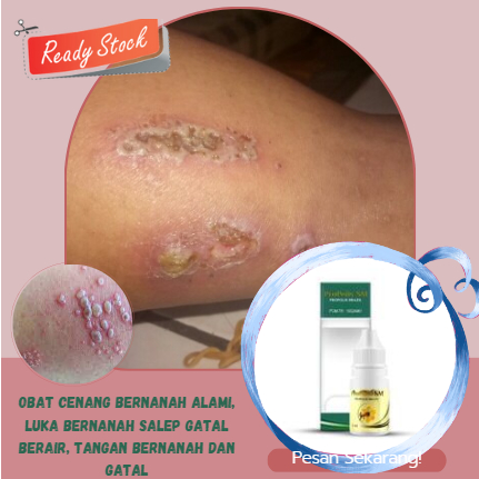 Obat Cenang Bernanah alami, Luka bernanah salep gatal berair, tangan bernanah dan gatal, salep gatal