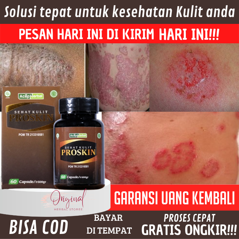 Obat Eksim kering dan basah, Salep eksim basah, Obat eksim, Obat Scabies Manusia, Salep eksim kering