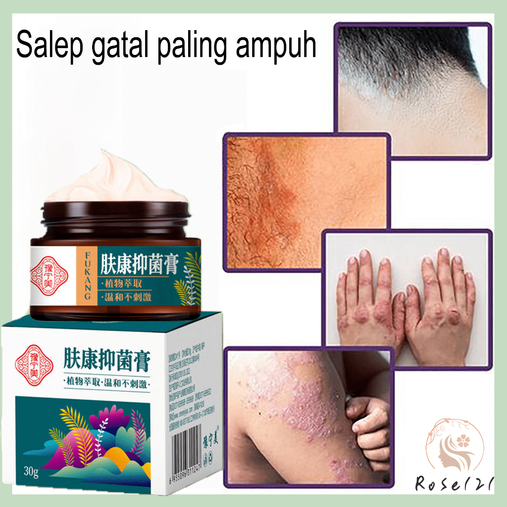 【100% Original】Salep gatal paling ampuh Obat psoriasis obat gatal salep kutil Obat Gatal Salep gatal Salep psoriasis 30G Tangan Tinea Penyakit kulit akut atau kronis eksim jamur hydatidosis sensasi eksternal lepuh kulit kaki gatal