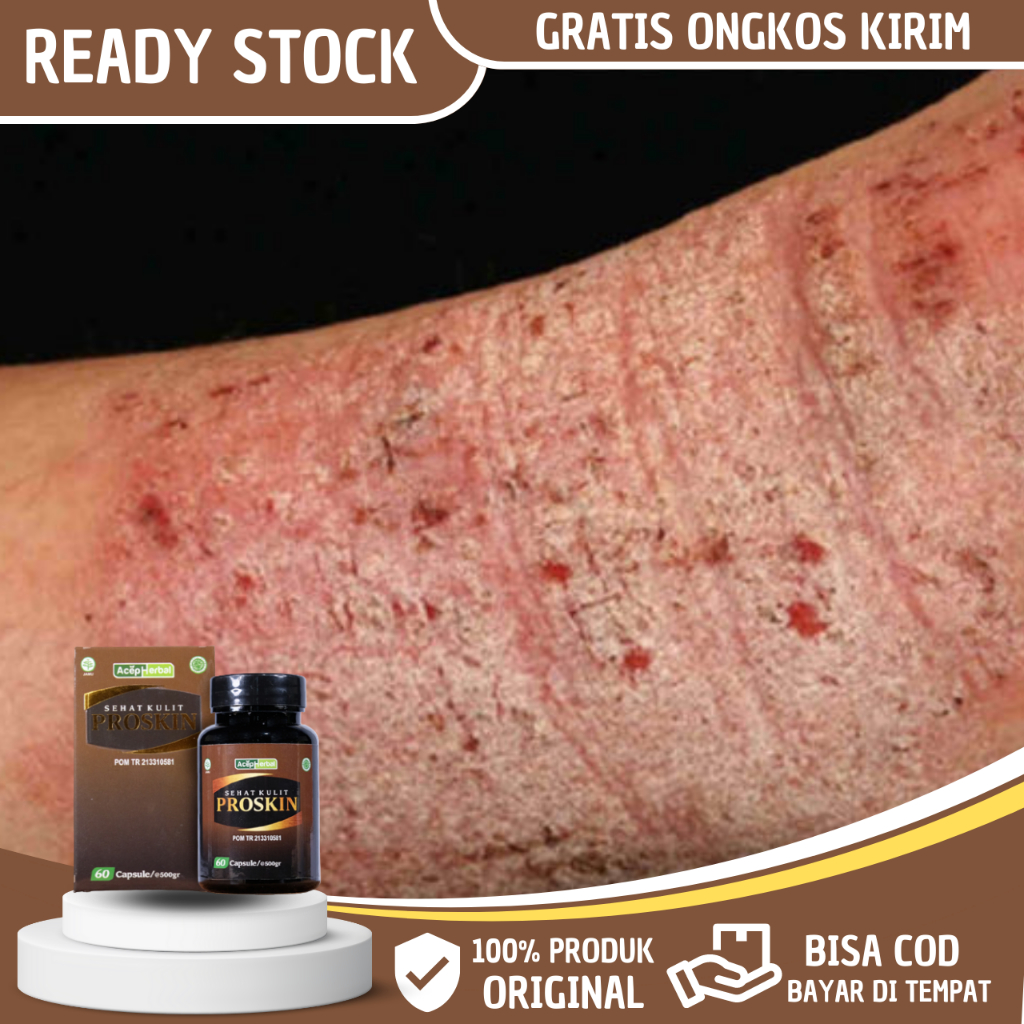 Obat Eksim Kering Menahun, Obat Herbal Eksim, Obat Eksim Kering, Obat Exim, Obat Gatal Gatal, Obat E