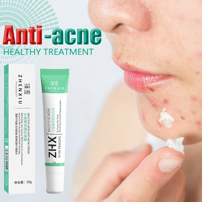 Krim Jerawat Pembersih Penghilang Jerawat Cream Jerawat Acne Cream 30g Membersihkan Kulit Secara Mendalam Menghilangkan Melanin Jerawat dan Bekas Jerawat Perawatan Kulit Unisex